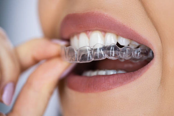 Dental Aligners