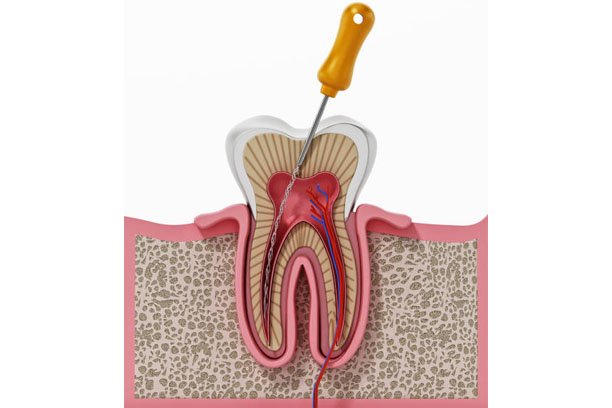Root Canal