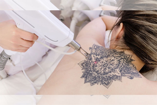 Tattoo removal
